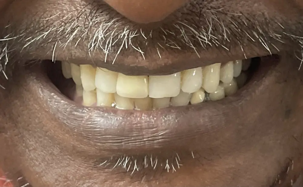 The same smile with the gap closed by a colour-matched crown