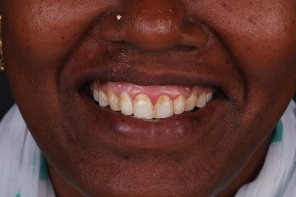 The same teeth after cleaning, with a firmer and healthier gum line