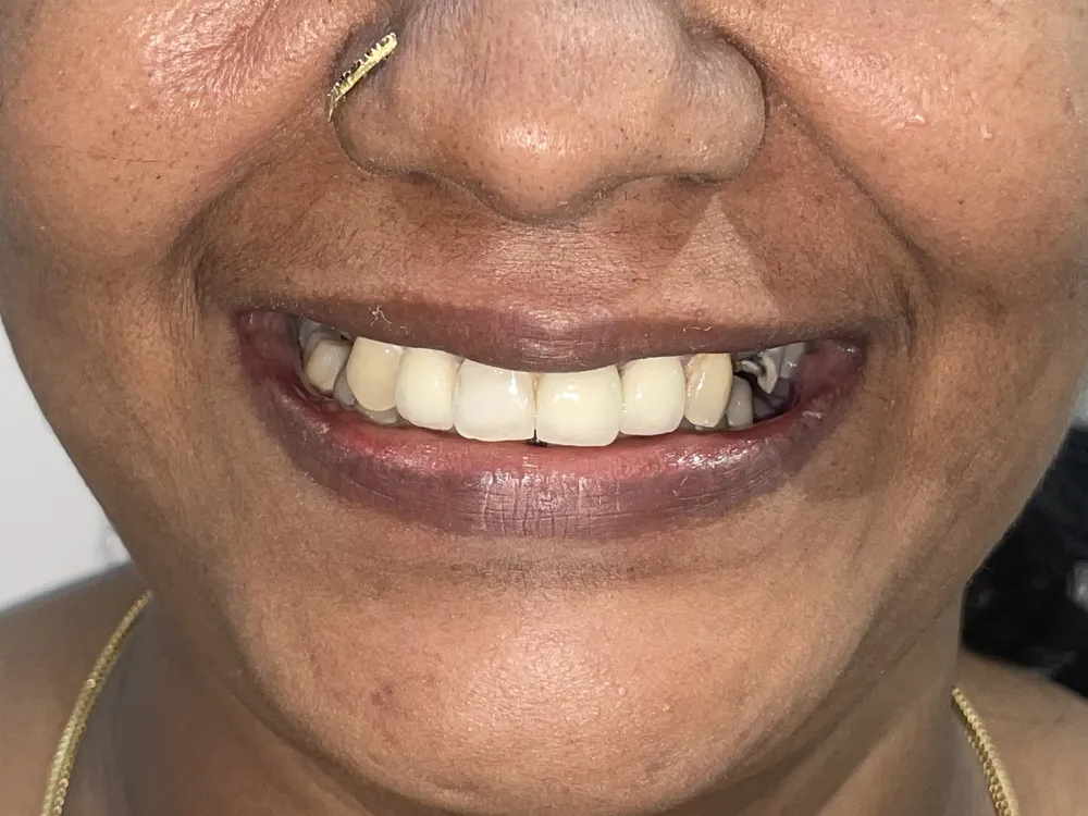 The same upper front teeth rebuilt to an even, uniform line