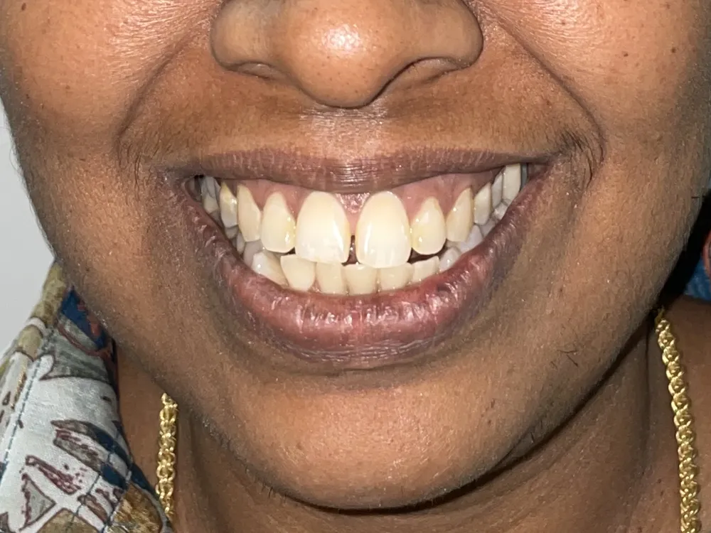 The same smile with the gap closed and the edges evened out