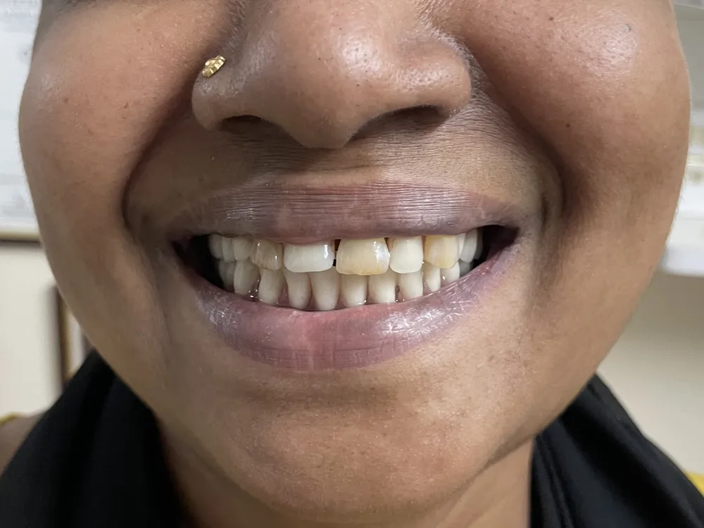 The same smile with a complete, even row of upper front teeth