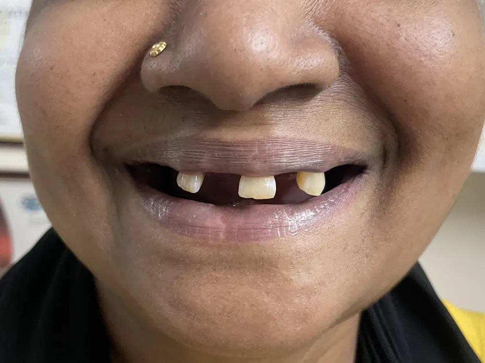 An upper arch with most of the front teeth missing, leaving wide gaps